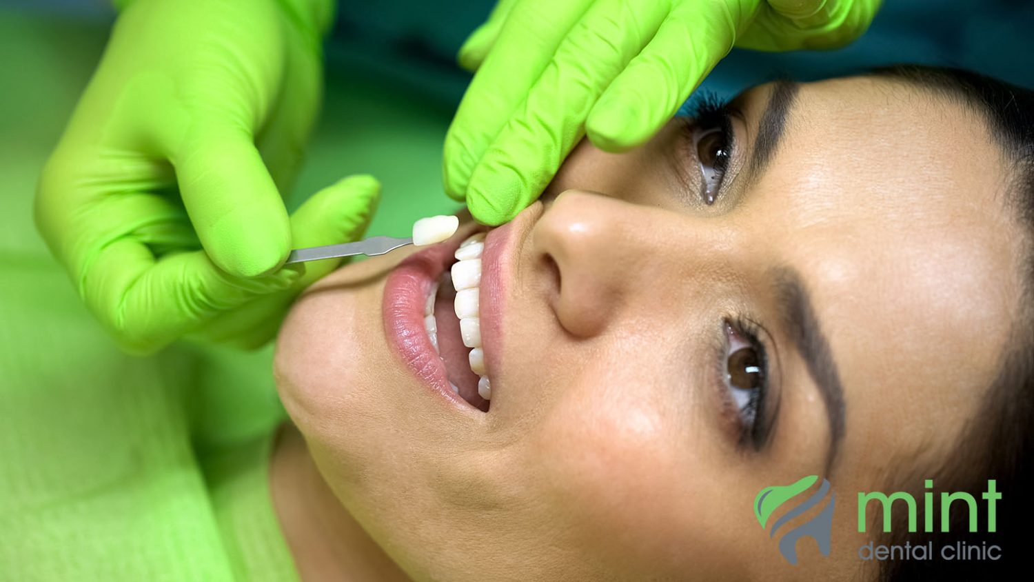 Photo of veneers being applied at Mint Dental
