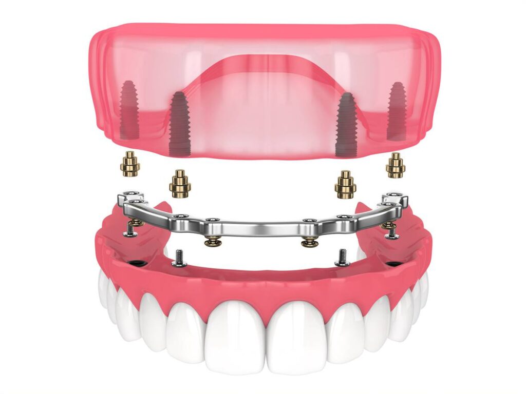 implant retained dentures