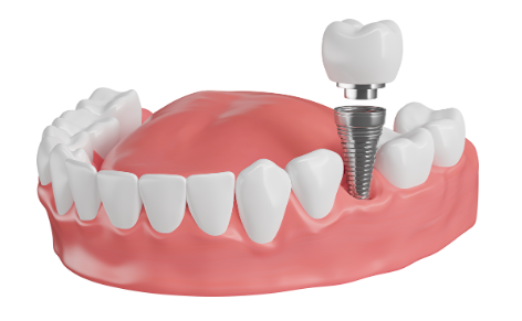 dental implant icon