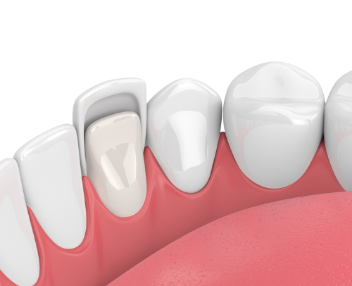 dental veneer icons