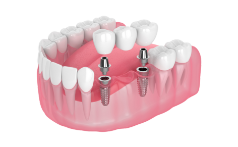 implant bridge illustration