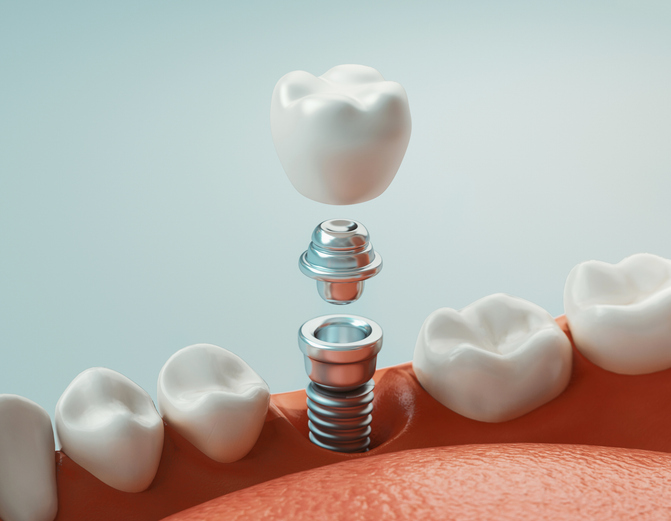 dental implant graphic render