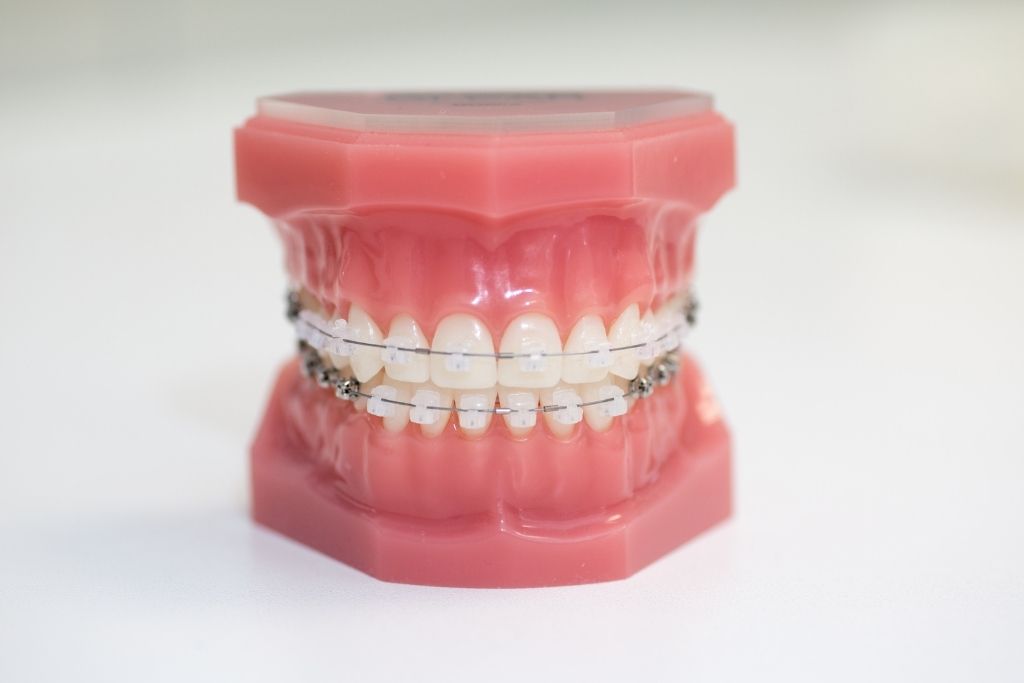 ura braces
