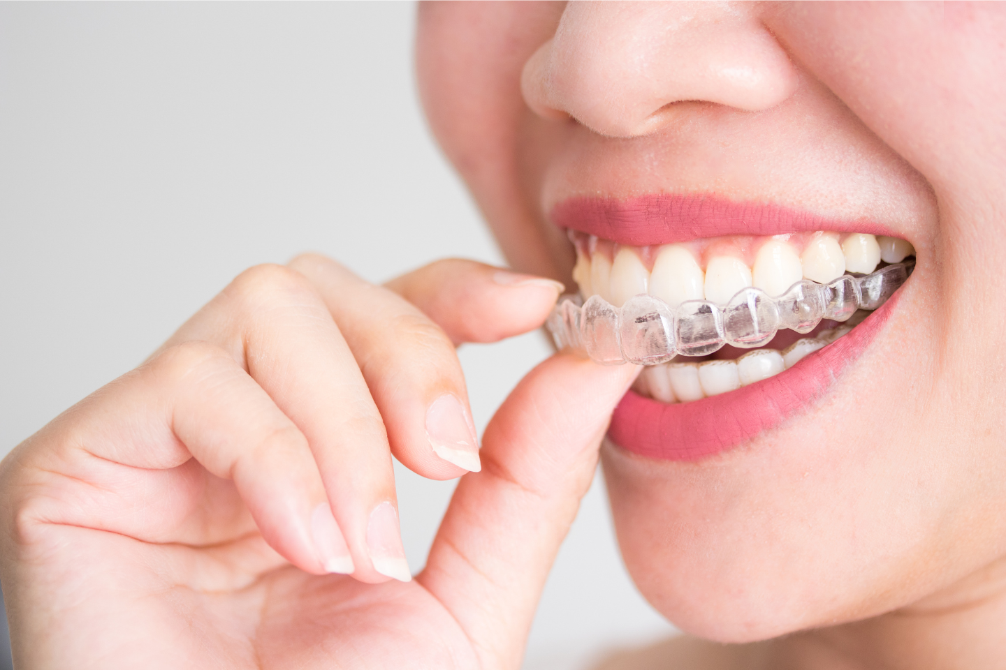 How Does Invisalign Work | Invisalign in London SE1
