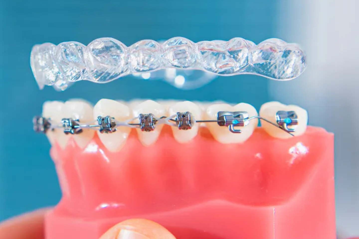 Are Metal Braces Better Than Clear Aligners | London SE1 Guide